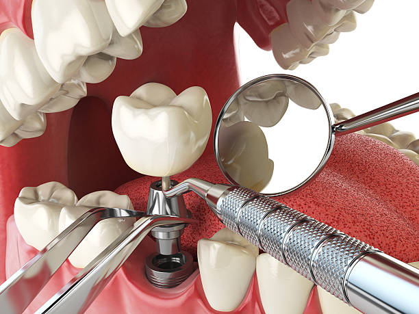Best Emergency Dentist for Lost Fillings or Crowns in Elk Plain, WA